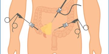 The Benefits of Minimally Invasive Laparoscopic Appendectomy for Patient Recovery