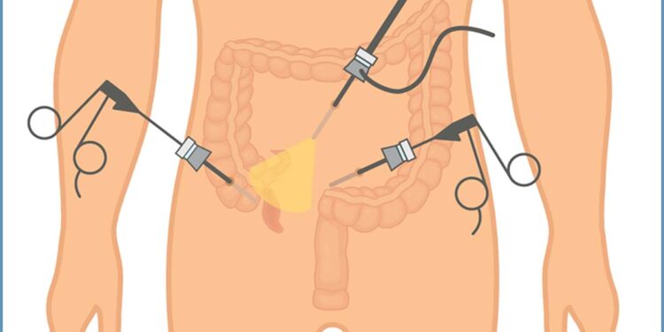 The Benefits of Minimally Invasive Laparoscopic Appendectomy for Patient Recovery