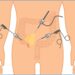 The Benefits of Minimally Invasive Laparoscopic Appendectomy for Patient Recovery