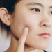 A Deep Dive into Skin Blemishes and Their Treatments
